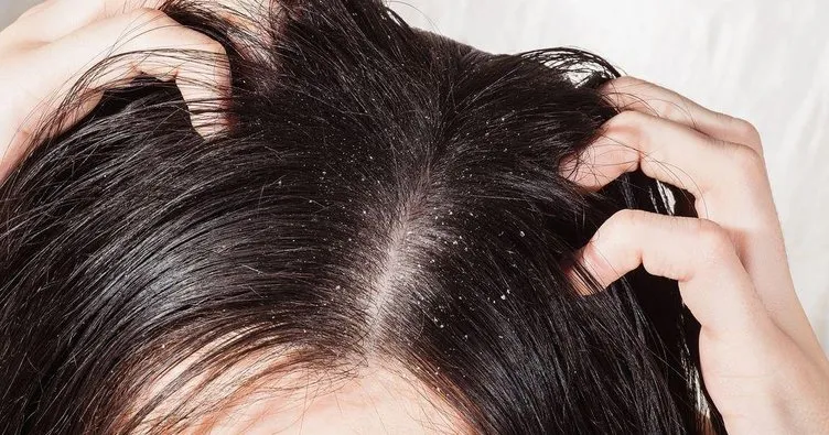 Kepeğe ne iyi gelir? Saç kepeklenmesi neden olur, kepek oluşumu nasıl engellenir?