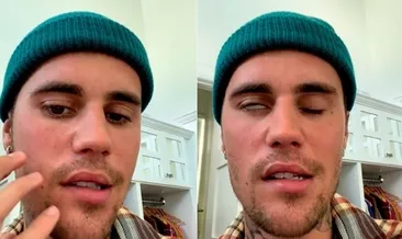 RAMSAY HUNT SENDROMU nedir, belirtileri nelerdir, tedavisi var mı? Justin Bieber’ın hastalığı nedir, Ramsay Hunt sendromu iyileşir mi?