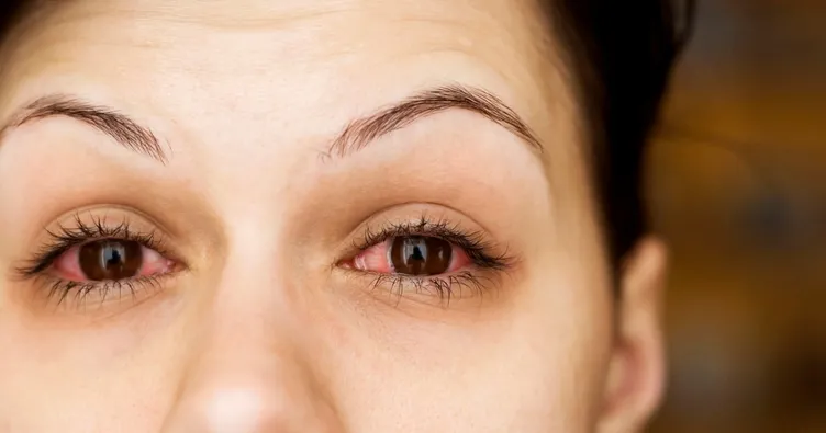 Huysuz hastalık Konjonktivit nedir? Konjonktivit nasıl bulaşır?