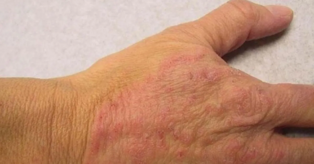 Mantar Hastaligi Nedir Neden Olur Vucutta Mantar Hastaligi Nasil Gecer Saglik Haberleri