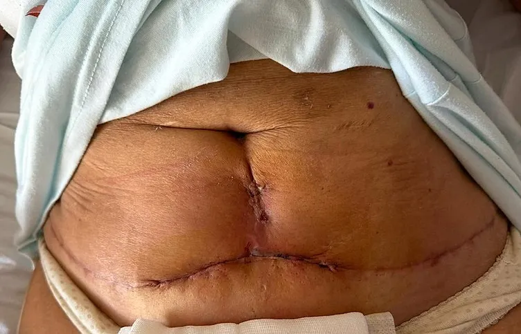 Kol ve karın germe ameliyatı hayatını kabusa çevirdi: Operasyondan tam 1 yıl sonra…