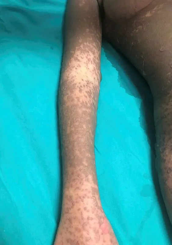 Psikiyatristin Verdigi Ilaclari Kullanan Genc Kiz Yasam Savasi Veriyor Son Dakika Haberler