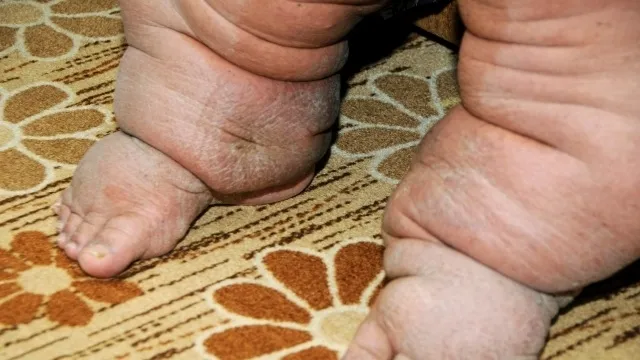 Fil Hastalığına Türk doktordan çare!