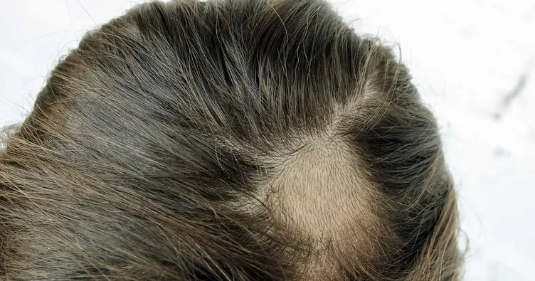 Saçkıran nedir, neden olur? Saçkıran belirtileri, tanı ve tedavi yöntemleri