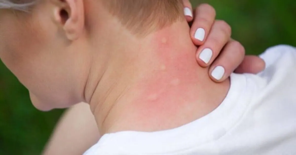 sivrisinek isirigina ne iyi gelir sinek isirigi sismesi nasil gecer saglik haberleri