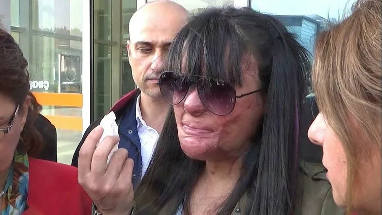Yüzü yakılan Berfin'den son dakika açıklaması: Pişmanım