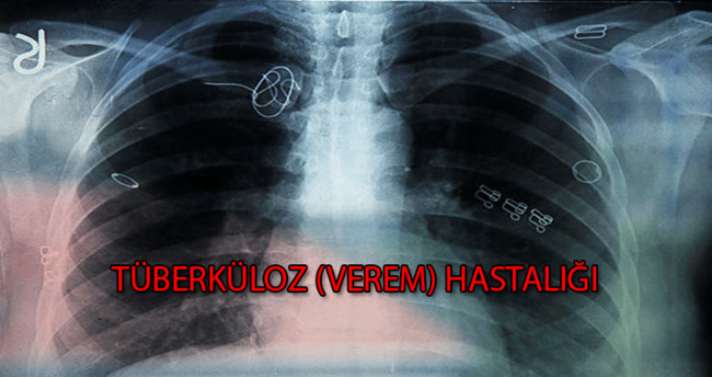 verem hastaliginin tedavisi var