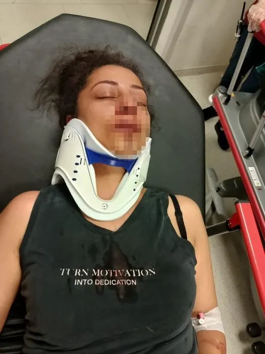 Korkunç pitbull kavgası: Kadının burnunu kırdı!