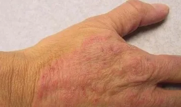 mantar enfeksiyonu anne adaylarini