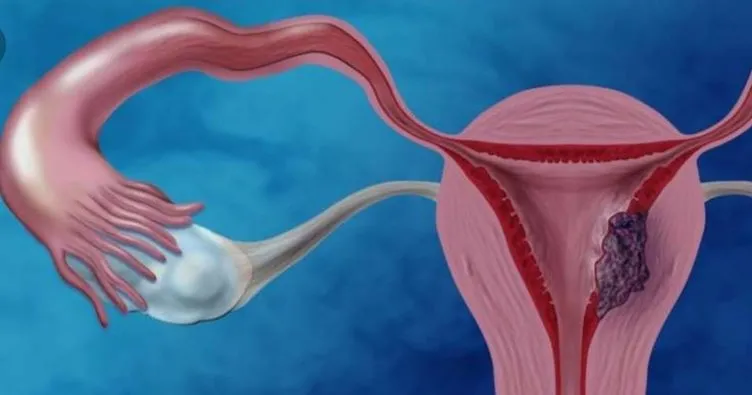 rahim kanseri belirtileri