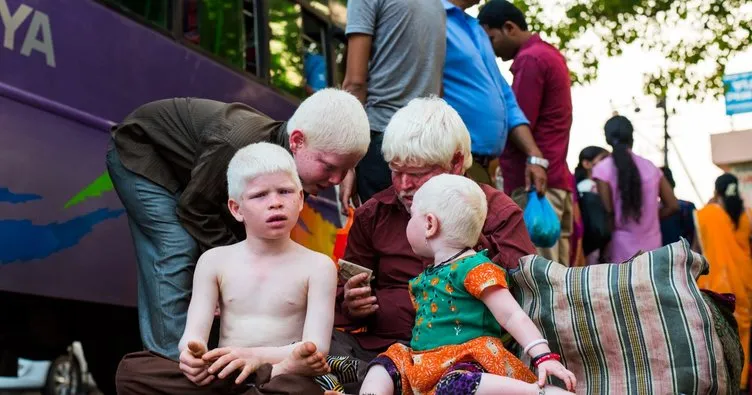 Beyaz melek albinolar ve görme kusurları