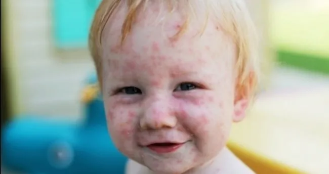 Çocuk hastalığı (Kelebek hastalığı) nedir? - Sağlık Haberleri