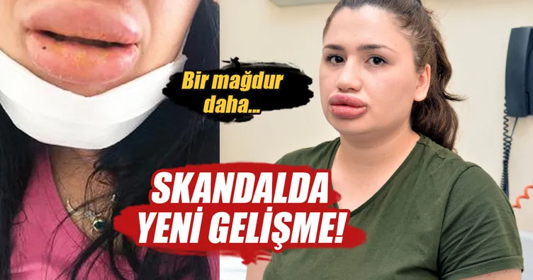 Silikon mağduru sadece Merve Keleş değilmiş!
