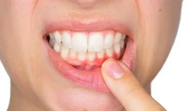 Diş Eti İltihabına Ne İyi Gelir? Antibiyotikle Geçmeyen Diş Eti İltihabı Nasıl Geçer, Belirtileri ve Evde Tedavisi Nedir?