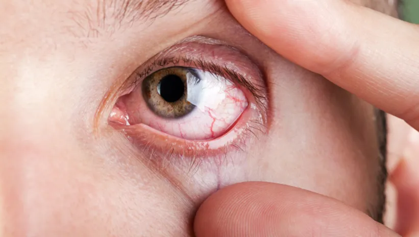 Bu hava sıcaklıklarına dikkat! Gözlerde büyük hasarın sebebi