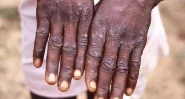 monkeypox-alarmi-yeni-bir-salgin-tehdidi-mi-1653103978160.jpg