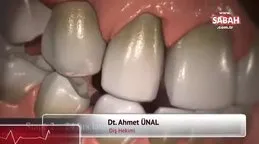 Diş taşı nasıl temizlenir? Diş taşı temizliği yöntemleri | Video