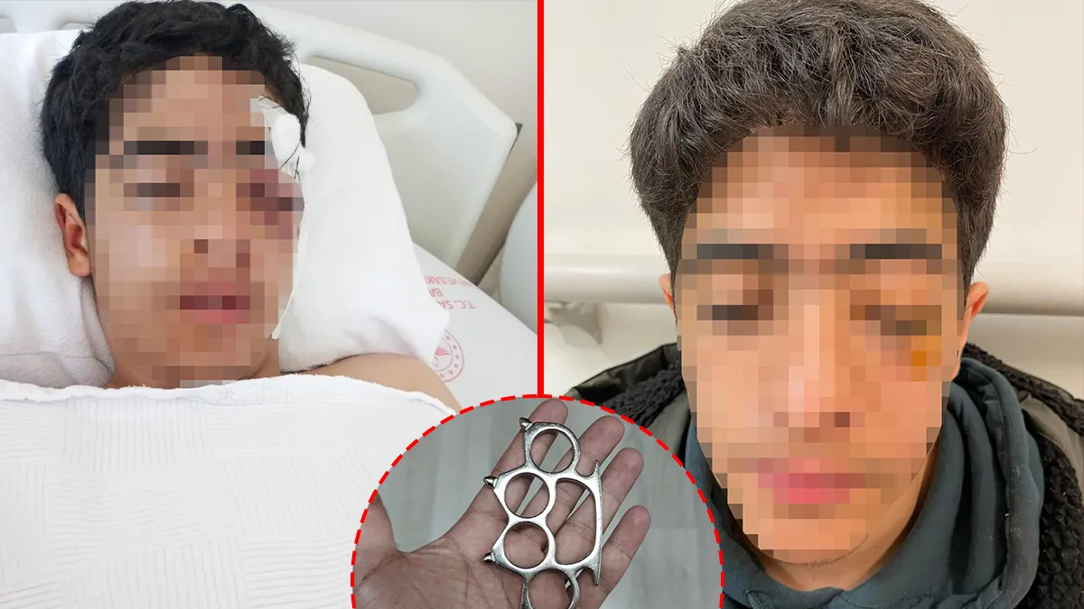 Esenyurt’ta akran zorbalığı! ‘Bana şaka yapma’ deyince muştalı saldırıya uğradı: 15 yaşındaki çocuğun gözünü kaybetme riski var! Esenyurt’ta akran zorbalığı! ‘Bana şaka yapma’ deyince muştalı saldırıya uğradı: 15 yaşındaki çocuğun gözünü kaybetme riski var!