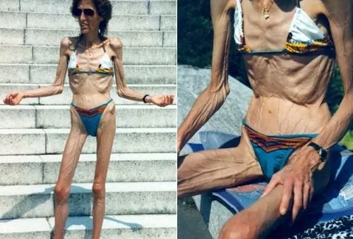 Anoreksiya sonu ölümle bitebilen bir hastalıktır