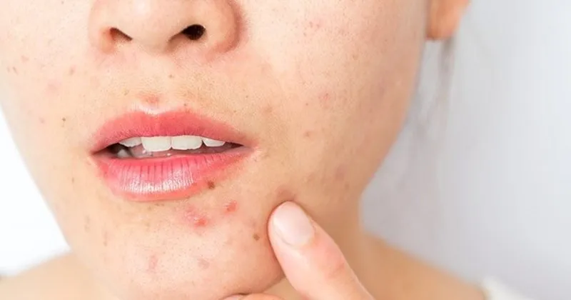 evde bitkisel sivilce kurutucu