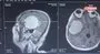 Beyin tümörlerinde zaman kaybı ölüme yol açıyor | Video
