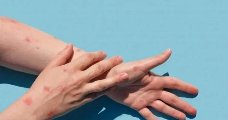 Maymun çiçeği belirtileri güncel belirtiler: Maymun çiçeği virüsü nedir, nasıl bulaşır, insandan insana bulaşır mı?