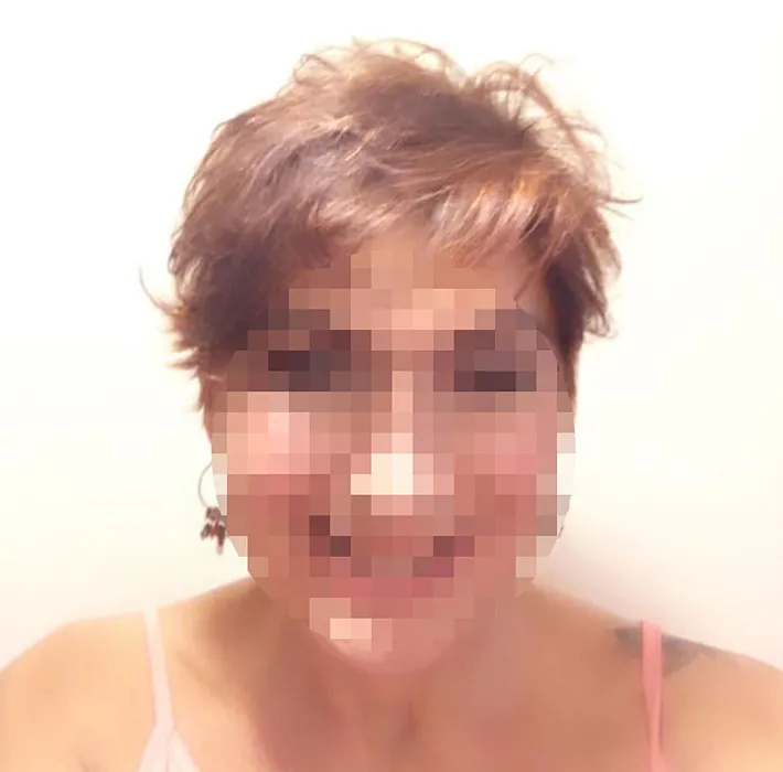 Kol ve karın germe ameliyatı hayatını kabusa çevirdi: Operasyondan tam 1 yıl sonra…