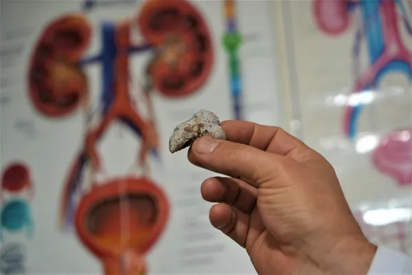 boyle-koleksiyon-gorulmedi-hastalarinin-bobreklerin-cikan-taslari-biriktiriyor-en-buyugunun-boyutu-1720518764569.jpg