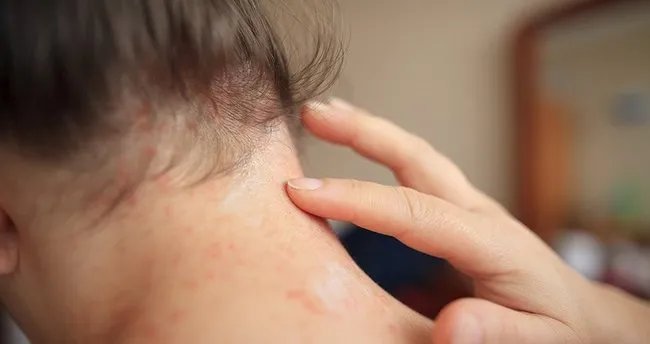 sedef hastaligi nedir nasil gecer