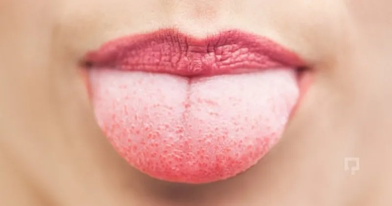 dil uyusmasi nedir dil uyusmasi nedenleri ve tedavisi saglik haberleri