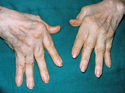 Romatoid artritin 5 önemli işareti!