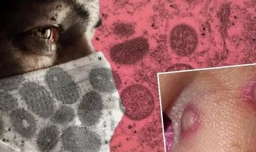 Çiçek aşısı yüzde 85 koruma sağlar