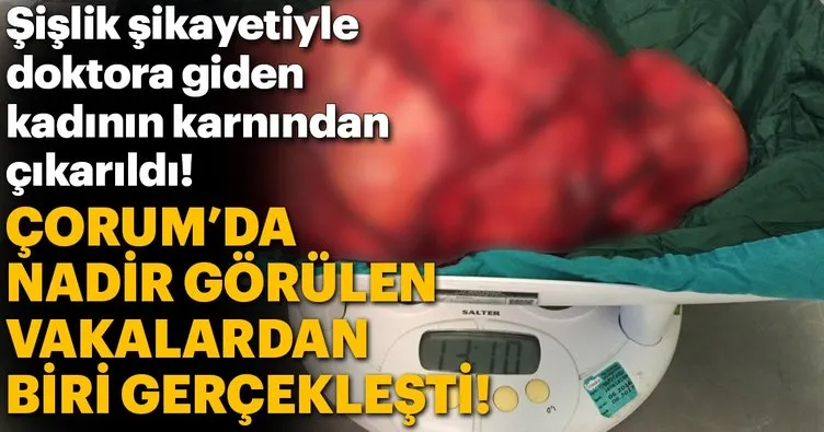 72 yaşındaki kadının karnından 35 santimlik tümör çıkarıldı