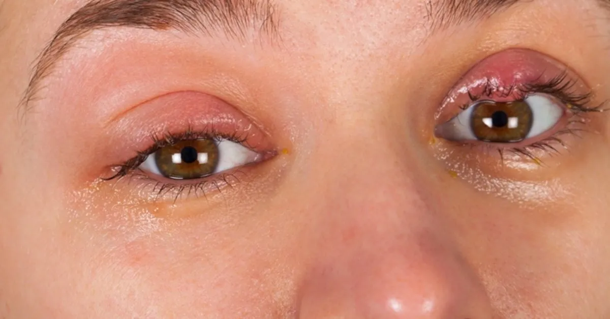 Gozde Arpacik Neden Cikar Evde Tedavi Ile Nasil Gecer Gozde Arpaciga Ne Iyi Gelir Saglik Haberleri