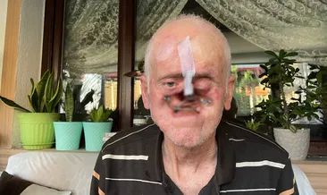 Sakarya’da Kazım Öztaş’ın burnunda çıkan sivilce hayatını kabusa çevirdi! Burnu her gün milim milim eridi!