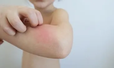Çocuğunuz alerjik bünyeli olabilir