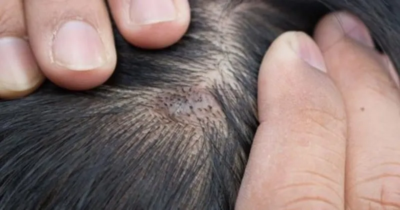 sac dipleri neden kasinir sac derisinde meydana gelen yara ve kasinti nasil gecer son dakika haberler