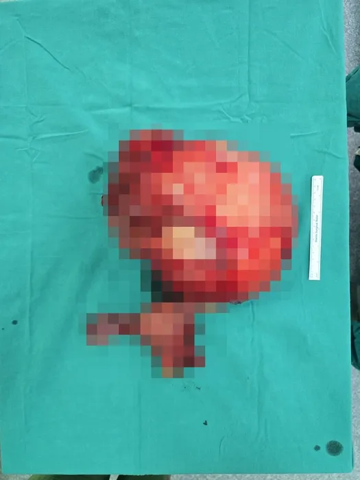 Karın ağrısı şikayetiyle hastaneye gitti! Karnından öyle bir şey çıktı ki! Tam 6 kilo!