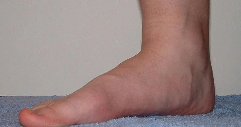 Duz Taban Nedir Duz Tabanlik Nasil Anlasilir Son Dakika Haberler