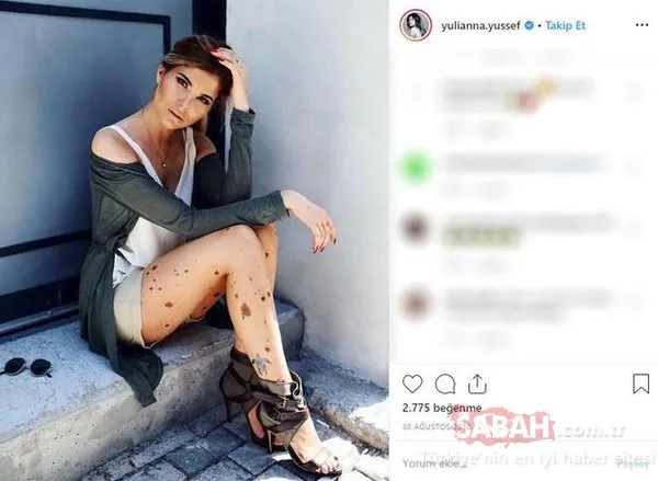 Cildi yüzünden herkes alay ediyordu... Şimdi dünya markaları peşinden koşuyor!