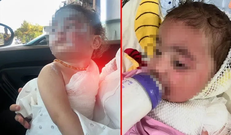 Anaokulunda üzerine kahve dökülen 1.5 yaşındaki Aden Aslan’da ikinci derece yanıklar oluştu! Kahrolan anne: Benim evladım acı çekiyor