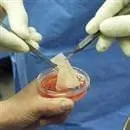 İlk kıkırdak nakli