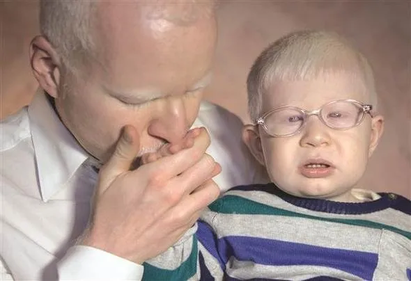 Türkiye’nin beyaz melekleri Albinolar