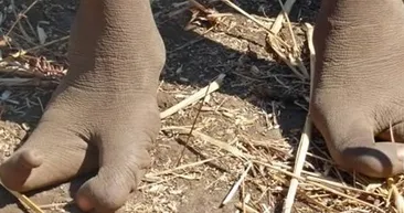 Dünyanın en tuhaf hastalıkları