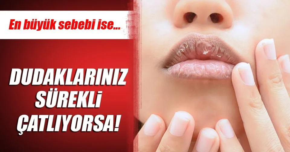 dudaklariniz surekli catliyorsa