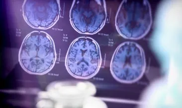 “Hafıza diyeti Alzheimer riskini azaltabilir”