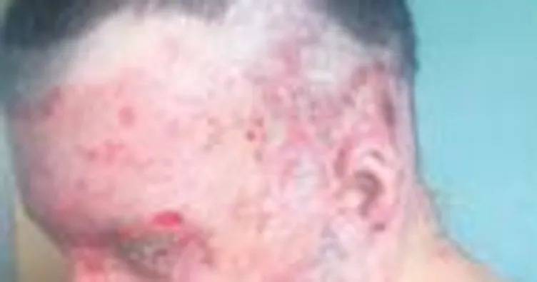 Hayat karartan kezzap için 5 yıl hapis