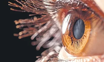 Göz içi tümörüne radyoaktif plak tedavisi