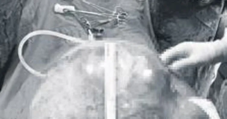 Karnından çıkan dev kitle şaşırttı