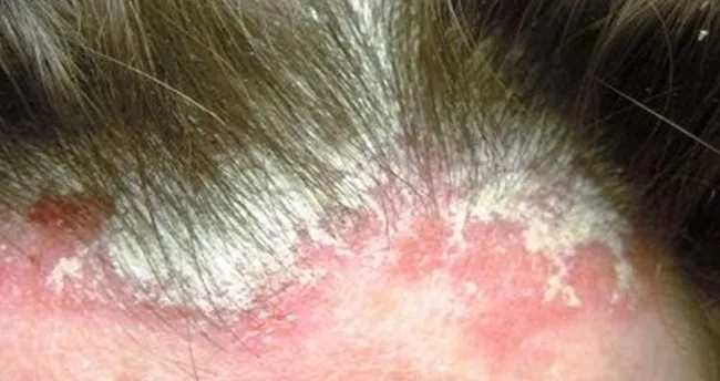 sacta seboreik dermatit tedavisi sac